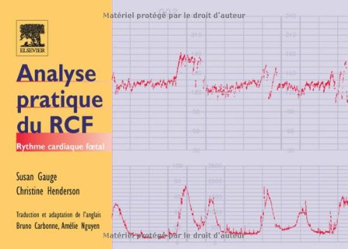 Analyse pratique du RCF - Rythme cardiaque foetal